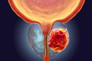 Importancia de la detección precoz del cáncer de próstata